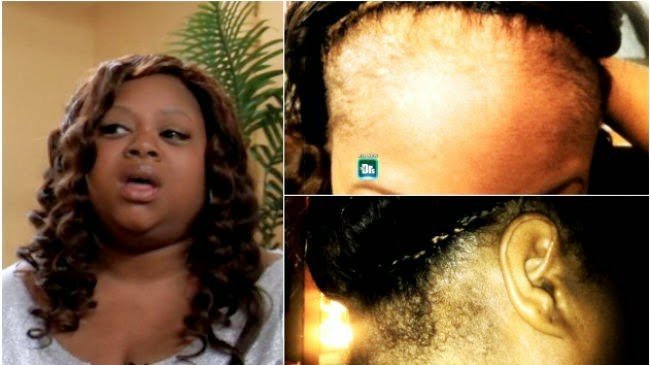 Can Human Hair Wigs Cause An Allergic Reaction?